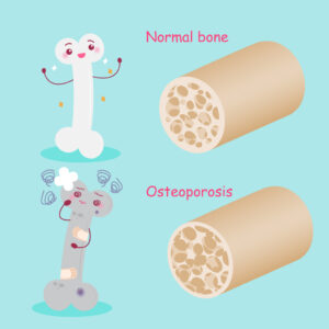 MK7 in bone health Osteoporosis